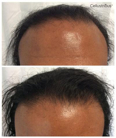 Minoxidil Foam